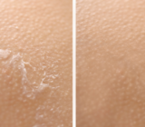 Dry Skin vs. Dehydrated Skin: What is the Real Difference?